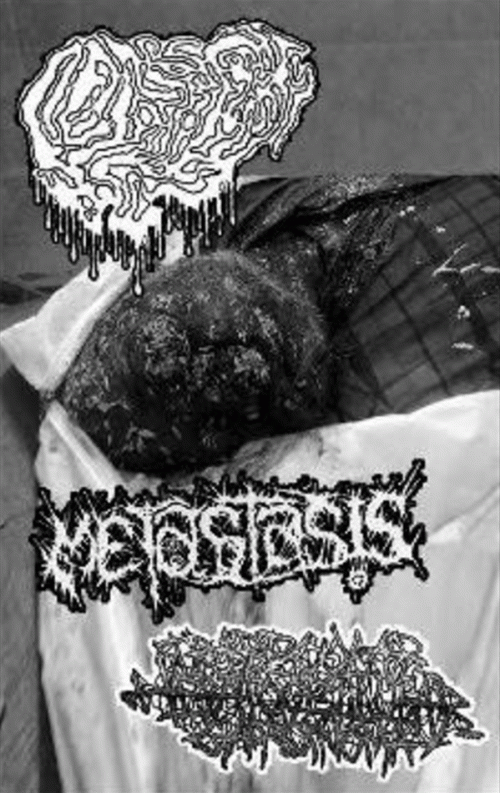 Trabecular Hepatocellular Carcinoma : Fetal Deformity - Metastasis - Trabecular Hepatocellular Carcinoma